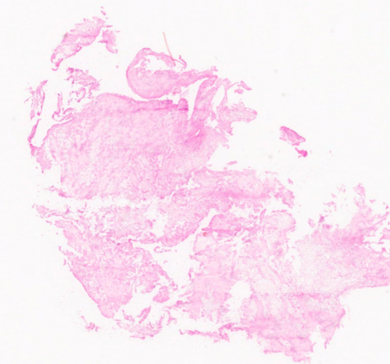 左侧股动脉病变